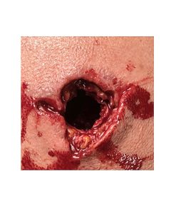 Tilläggsmodul (PRO) för integrerad skottskada höger ljumske/bäcken